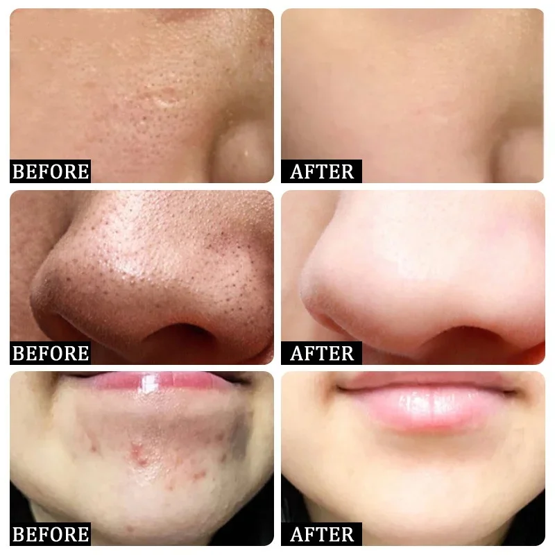 Salicylic Acid Pore Clearing C - Salicylic Acid Blackhead Remover 评论和价格