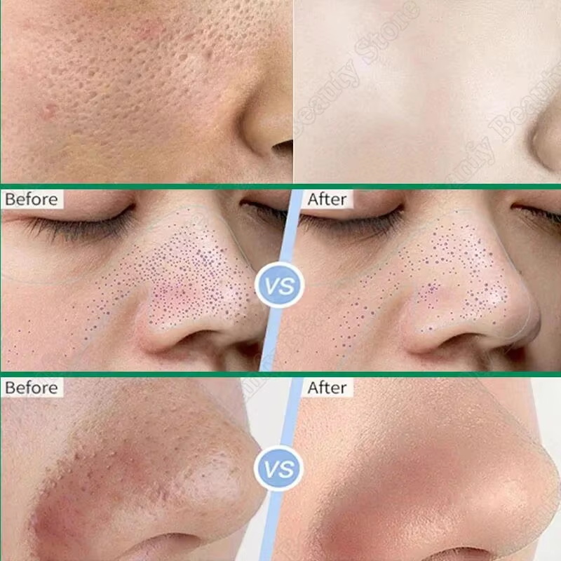 Salicylic Acid Pore Clearing C - Salicylic Acid Blackhead Remover 评论和价格